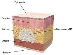 Click image for larger version. 

Name:	macrolane_injection_anatomy_300x225_100.jpg 
Views:	49 
Size:	30.8 KB 
ID:	1133645