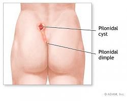 Click image for larger version. 

Name:	pilonidalcyst_174.jpg 
Views:	3462 
Size:	33.2 KB 
ID:	289130