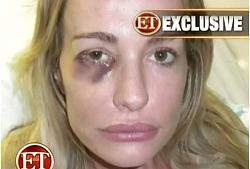 Click image for larger version. 

Name:	taylor-armstrong-black-eye-front-real-housewives-of-beverly-hills.jpg 
Views:	292 
Size:	41.5 KB 
ID:	572240