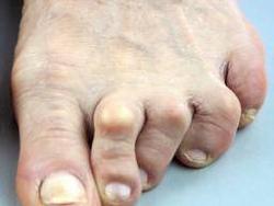 Click image for larger version. 

Name:	arthritis-in-the-feet-and-toes-causing-pain-and-walking-issues.jpg 
Views:	55 
Size:	6.4 KB 
ID:	1129675