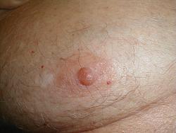 Click image for larger version. 

Name:	thorax_invertednipple1_155.jpg 
Views:	1362 
Size:	169.1 KB 
ID:	81618