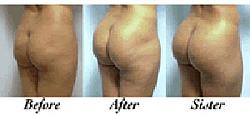 Click image for larger version. 

Name:	microfat_injections_pic_199.jpg 
Views:	592 
Size:	19.1 KB 
ID:	254286