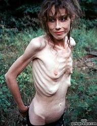 Click image for larger version. 

Name:	anorexia-woman.jpg 
Views:	429 
Size:	21.6 KB 
ID:	394747