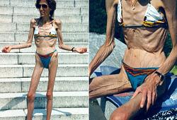 Click image for larger version. 

Name:	extreme-anorexic-woman.jpg 
Views:	422 
Size:	50.7 KB 
ID:	394752