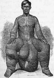 Click image for larger version. 

Name:	Elephantiasis-affecting-scrotum-legs-and-arms-After-photo.jpg 
Views:	3223 
Size:	9.0 KB 
ID:	567861