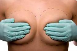 Click image for larger version. 

Name:	breastimplants.jpg 
Views:	71 
Size:	7.3 KB 
ID:	440044