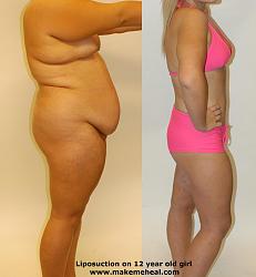Click image for larger version. 

Name:	liposuction1_113.jpg 
Views:	1634 
Size:	121.2 KB 
ID:	233836