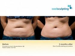 Click image for larger version. 

Name:	COOLSCULPTb4after5.jpg 
Views:	2759 
Size:	11.3 KB 
ID:	559721