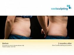 Click image for larger version. 

Name:	COOLSCULPTb4after7.jpg 
Views:	2748 
Size:	10.3 KB 
ID:	559722