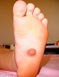Click image for larger version. 

Name:	ugly foot.jpg 
Views:	2317 
Size:	48.9 KB 
ID:	409231