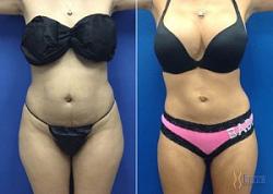 Click image for larger version. 

Name:	tummy-0061-300x214.jpg 
Views:	41 
Size:	16.8 KB 
ID:	1049331
