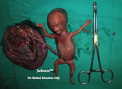 Click image for larger version. 

Name:	Therapeutic+abortion.jpg 
Views:	73 
Size:	94.4 KB 
ID:	878153