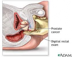 Click image for larger version. 

Name:	prostate.png 
Views:	220 
Size:	74.0 KB 
ID:	847967